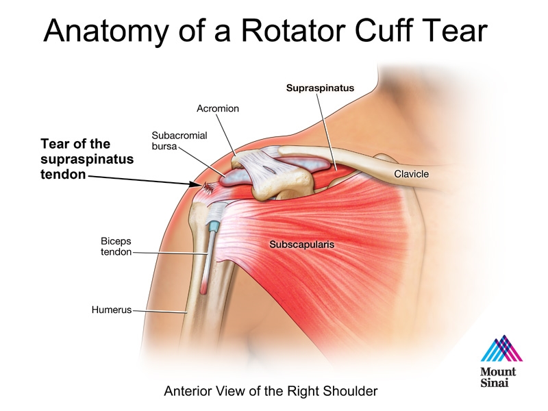 Anatomy-of-Rotator-Cuff-Tear.jpg