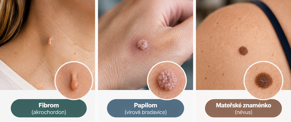 Kožní výrůstky: Kdy jde o pouhou estetickou vadu a kdy navštívit dermatologa?